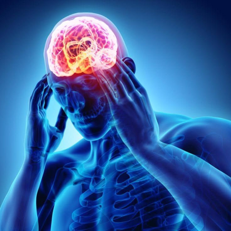 migraine